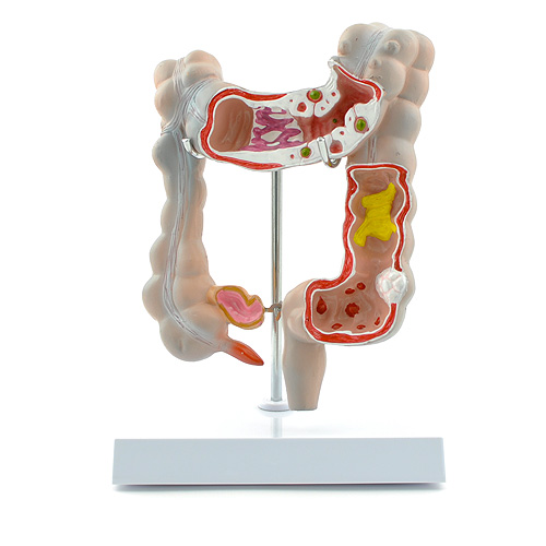 HEINESCIENTIFIC Menschlicher Dickdarm als Schnittmodell mit mehreren Krankheitsbildern