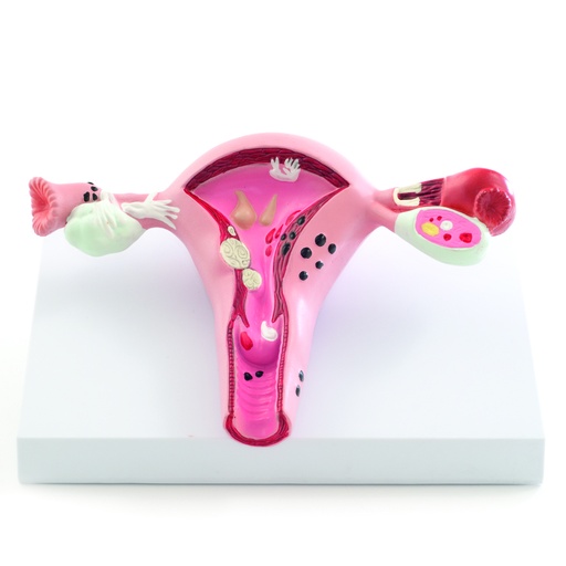 [14728-01] HEINESCIENTIFIC Anatomical model of uterine diseases