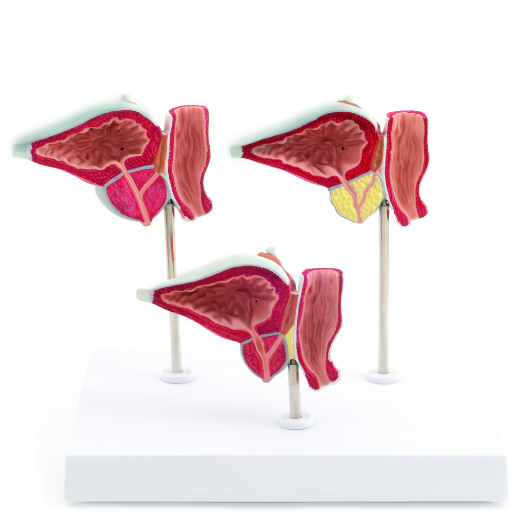 HEINESCIENTIFIC Dreiteiliges Modell der Prostataerkrankungen