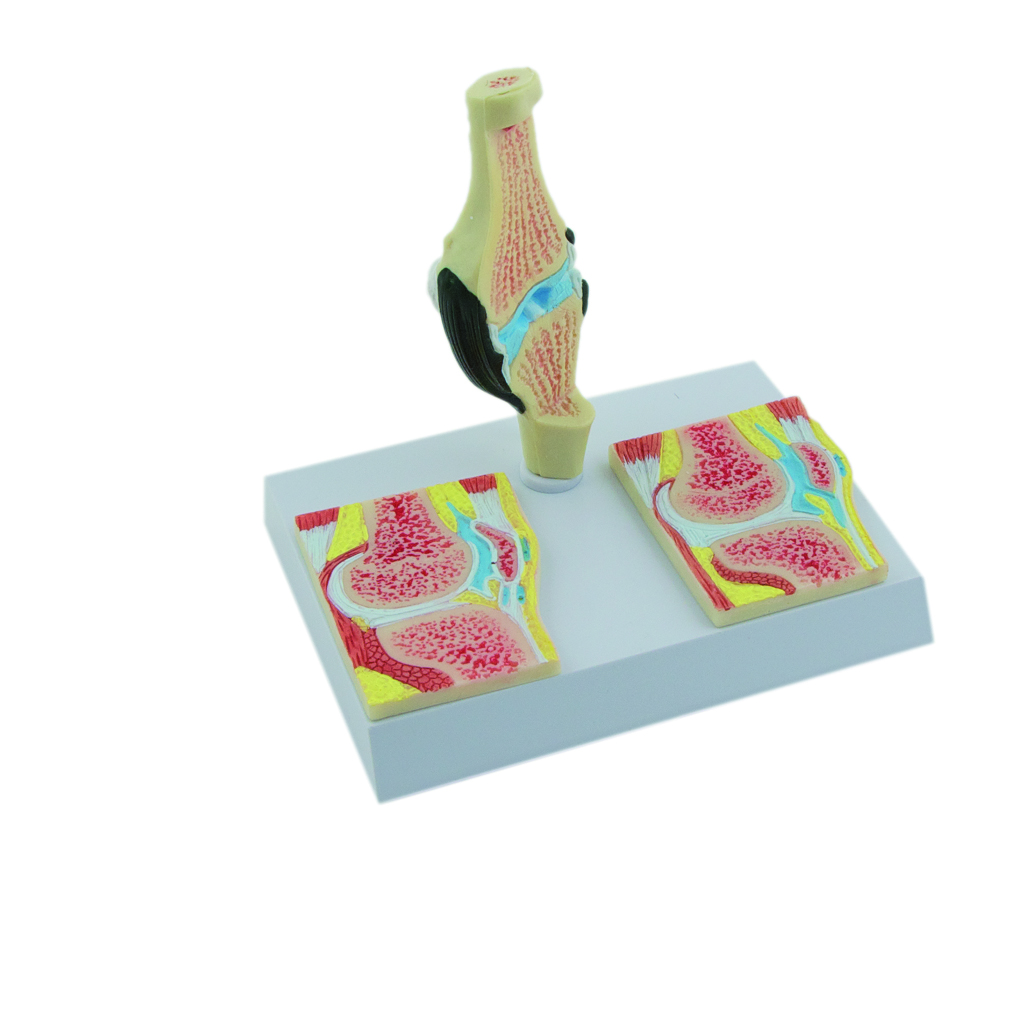 HEINESCIENTIFIC Knee model with rheumatism stages