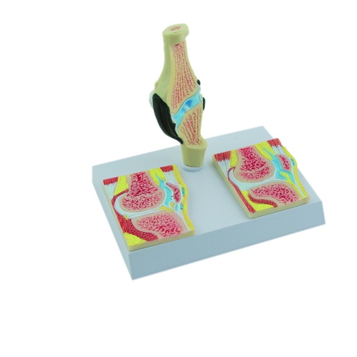 [14771-01] HEINESCIENTIFIC Knee model with rheumatism stages