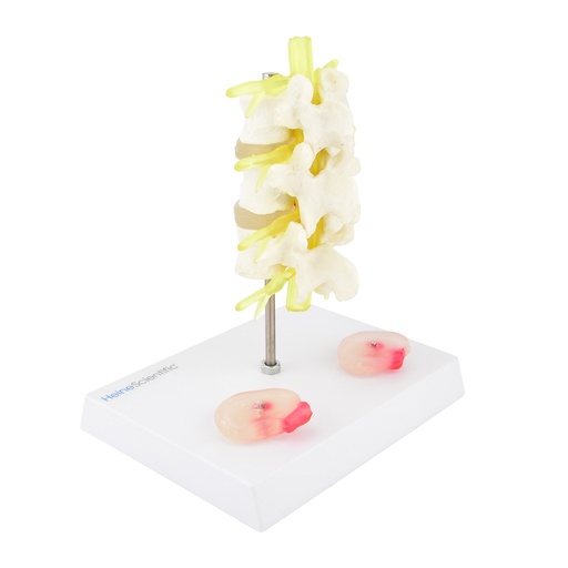 [14790-01] HEINESCIENTIFIC Herniated disc model