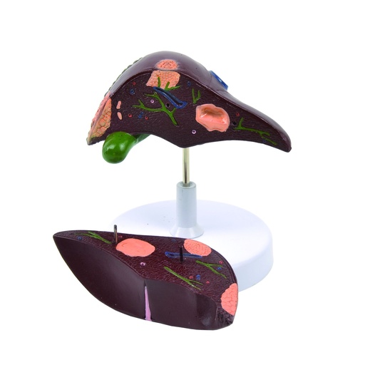 [14809-01] HEINESCIENTIFIC Model of the liver with various diseases