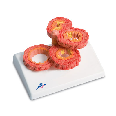 [18785-01] 3B Scientific COPD Modell