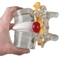 ERLERZIMMER Disc Prolapse Simulator
