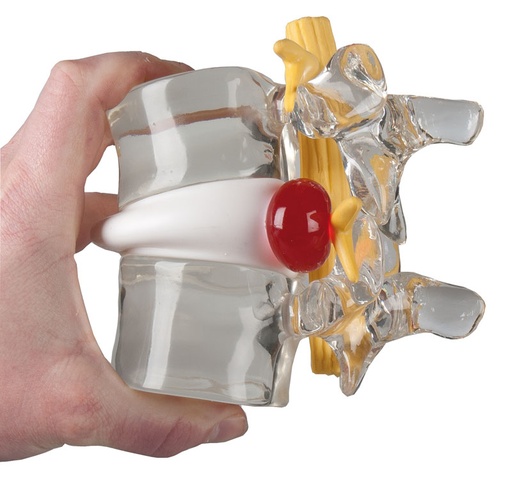 [20268-01] ERLERZIMMER Disc Prolapse Simulator