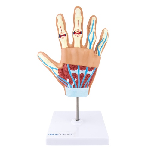 [21508-01] HEINESCIENTIFIC Handmodell mit rheumatoider Arthritis