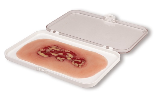[23480-01] ERLERZIMMER Wound Moulage Venous Leg Ulcer small Exudation Phase