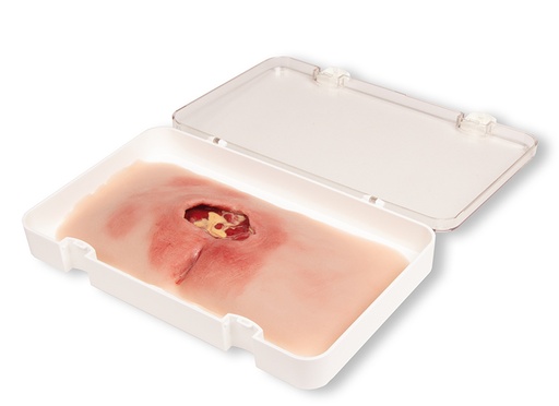 [23481-01] ERLERZIMMER Wound Moulage Sacral Decubitus, cleaned