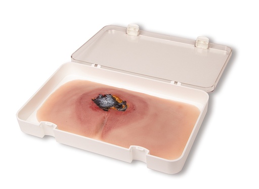 [23483-01] ERLERZIMMER Wound Moulage Sacral Decubitus untreated
