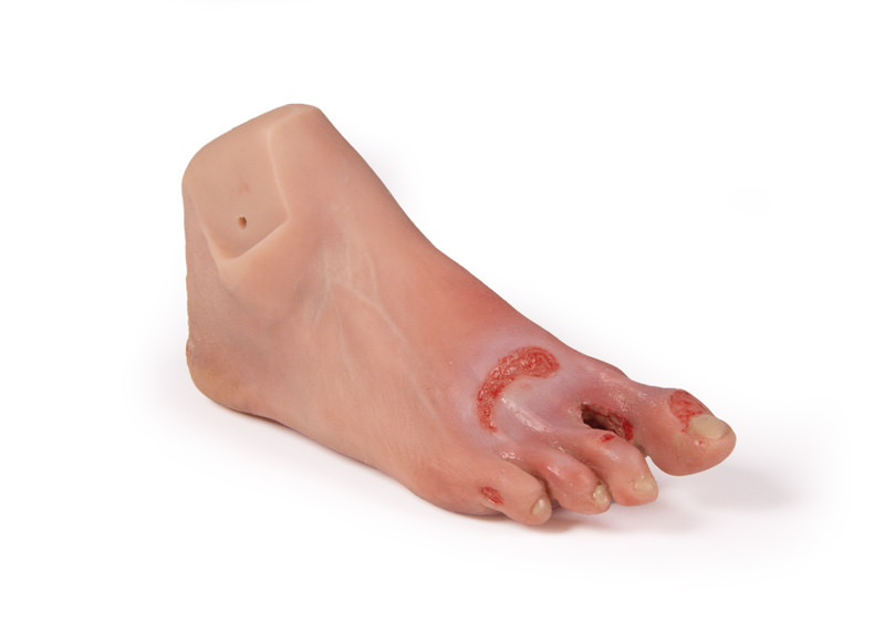 ERLERZIMMER Wound Foot with Diabetic Foot Syndrome, adv. stage, manikin version