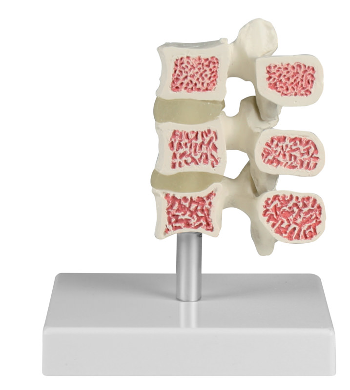 ERLERZIMMER Osteoporose-Wirbel-Modell, 3 Wirbel