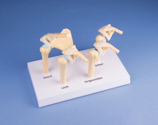 [24348-01] ERLERZIMMER 4-Stadien-Osteoarthritis (OA) Schulter