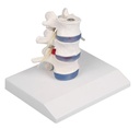 ERLERZIMMER Lumbar Vertebra with Disc Herniation