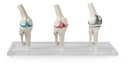 ERLERZIMMER Knie-Implantat-Modell