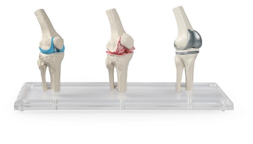 [24560-01] ERLERZIMMER Knie-Implantat-Modell