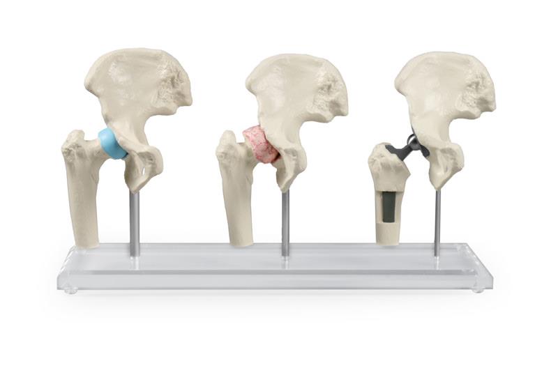 ERLERZIMMER Hip Implant Model
