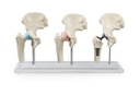 ERLERZIMMER Hip Implant Model