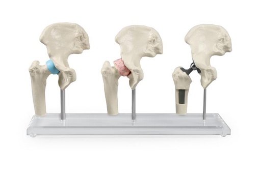 [24561-01] ERLERZIMMER Hip Implant Model
