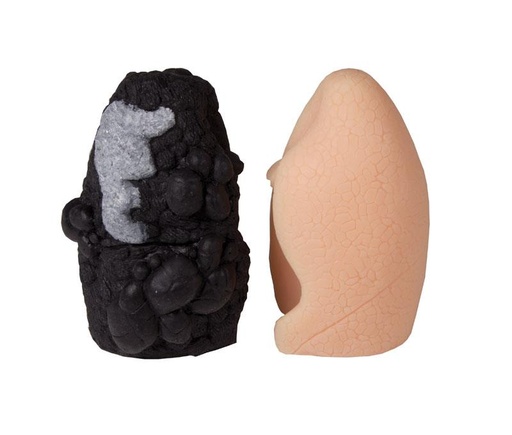 [24578-01] ERLERZIMMER Lungenkrebs-Vergleichsmodell