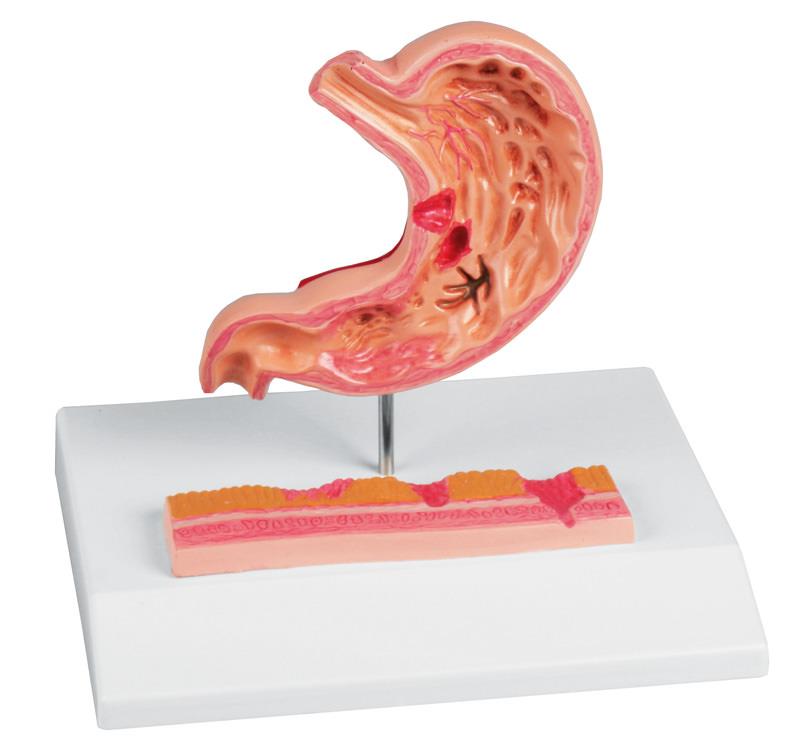 ERLERZIMMER Stomach with Gastric Ulcers
