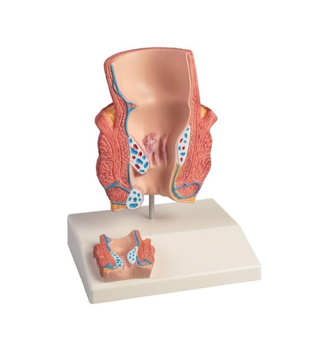 [24585-01] ERLERZIMMER Hemorrhoid Model, 2-times size
