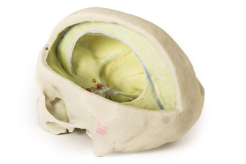 ERLERZIMMER Schädelmodell mit Ansatz der Dura mater