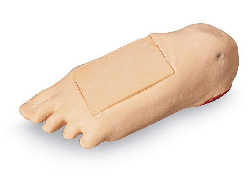 ERLERZIMMER Edema Foot with deep Tissue Necrosis