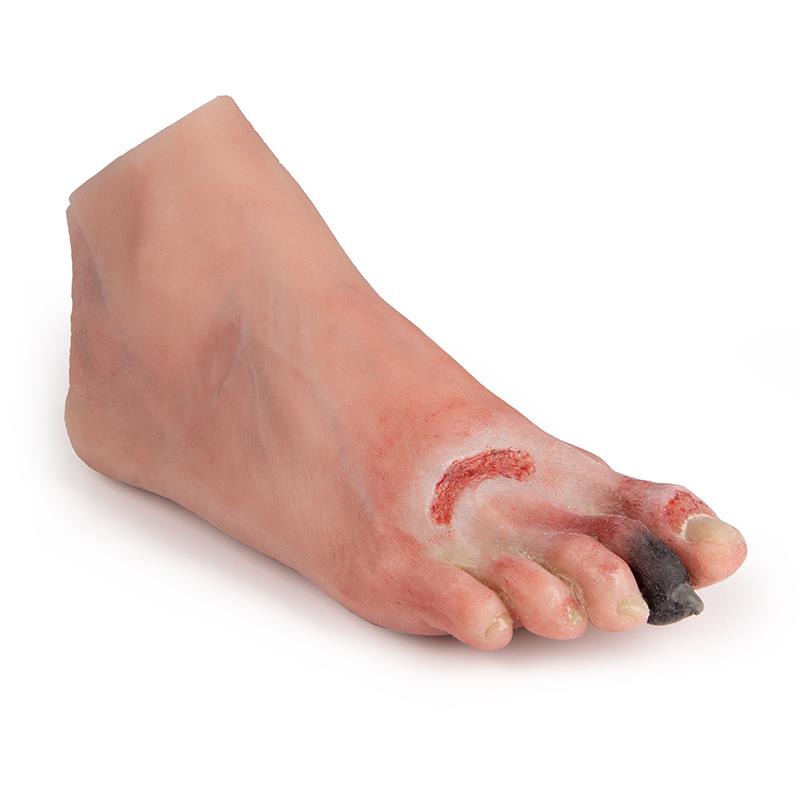 ERLERZIMMER Wound Foot with Diabetic Foot Syndrome