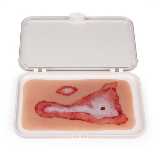 [24683-01] ERLERZIMMER Wound Moulage Scalding