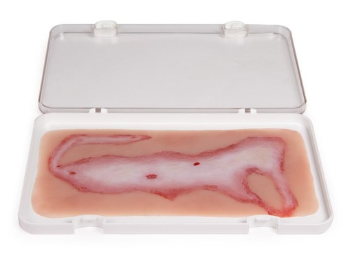 [24684-01] ERLERZIMMER Wound Moulage Scalding