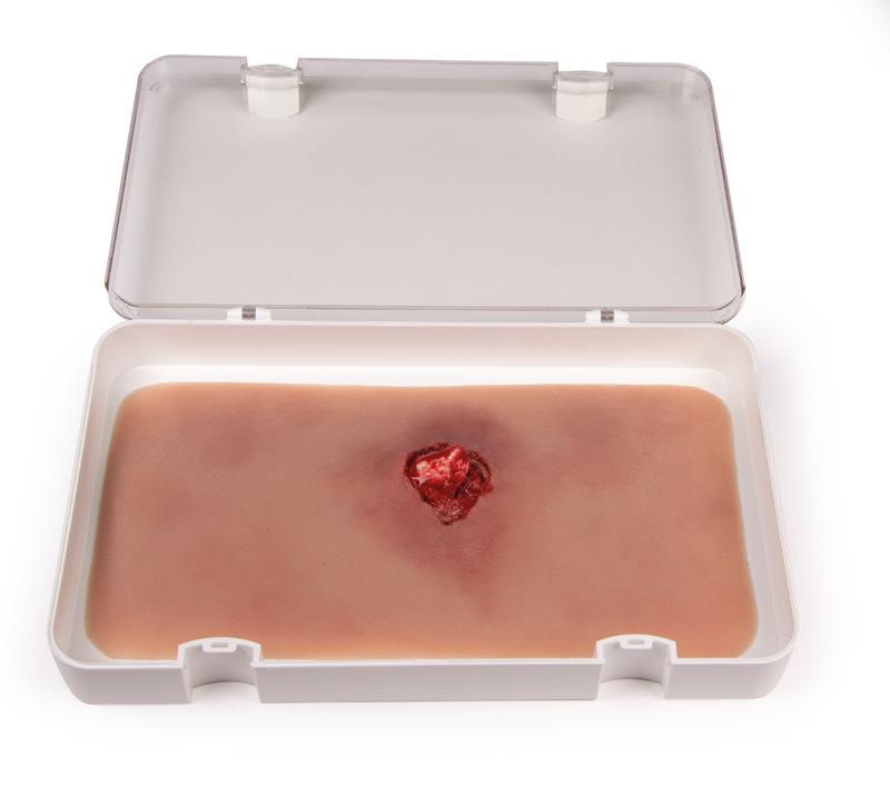 ERLERZIMMER Open Fracture Arm with Bleeding Function