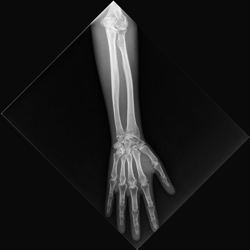 ERLERZIMMER X-Ray Phantom Forearm, opaque