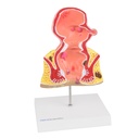HEINESCIENTIFIC Rectum model with diseases