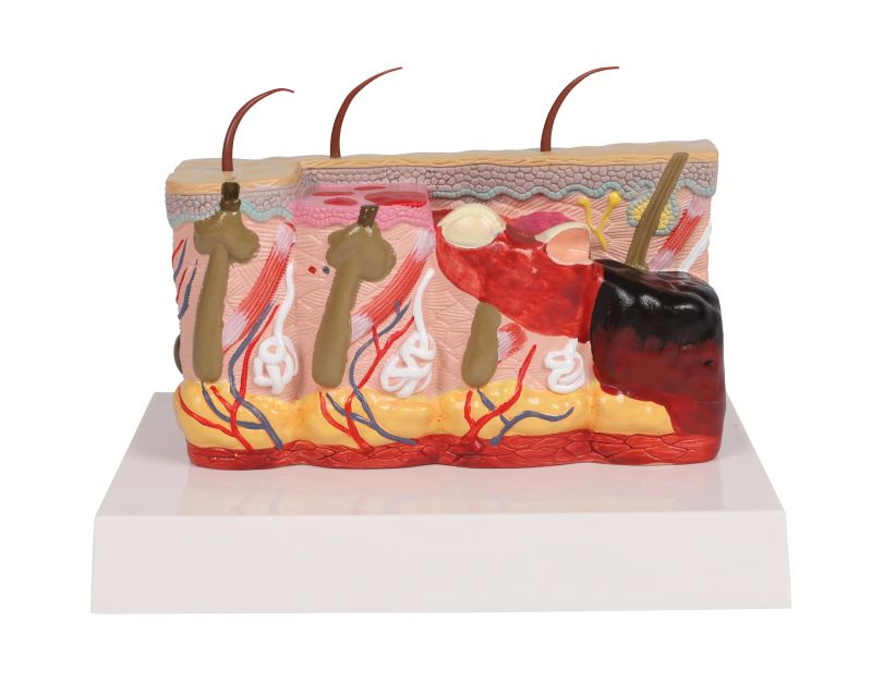 ERLERZIMMER Pathological Skin Model with Burn, 30-times size