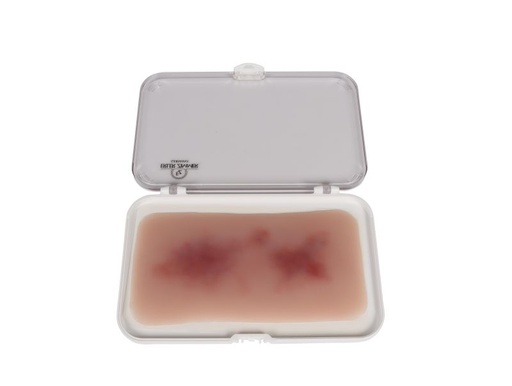 [27402-01] ERLERZIMMER Wound Moulage Hematoma Fresh